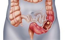 Tiêu chảy phân mỡ và nguy cơ với sức khỏe